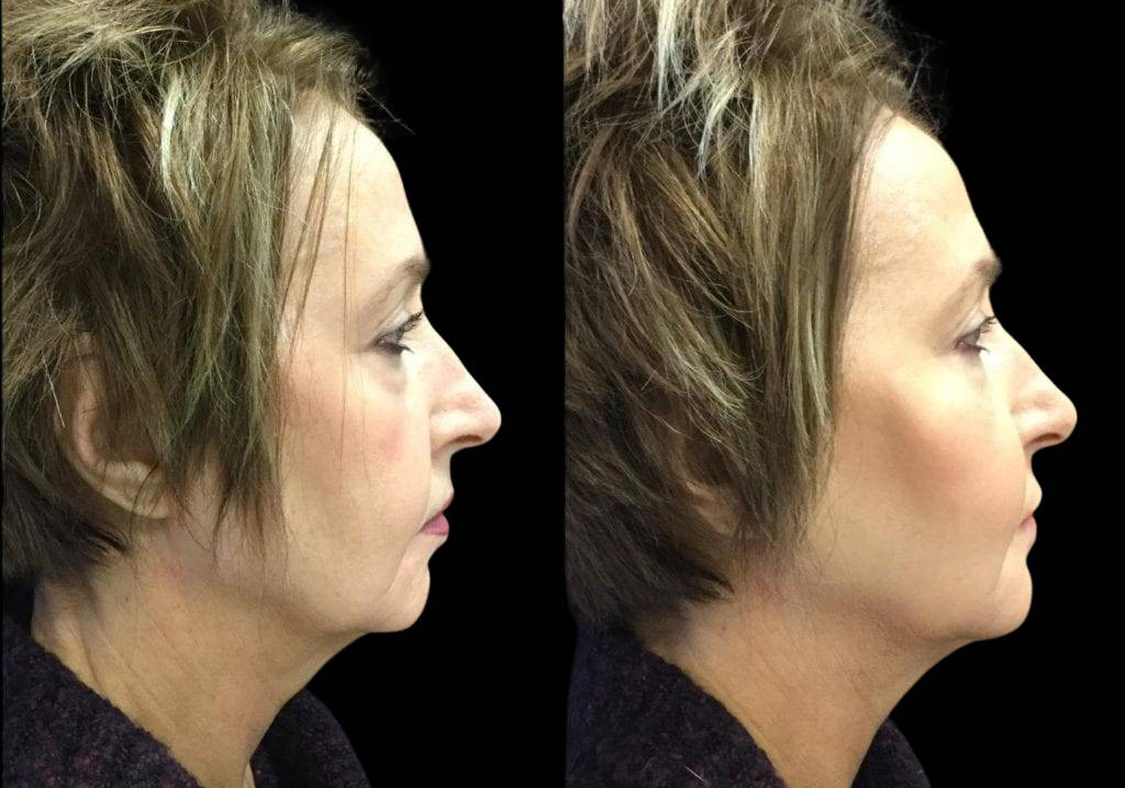 57-year-old-female-non-surgical-facelift-before-and-after-2.jpg