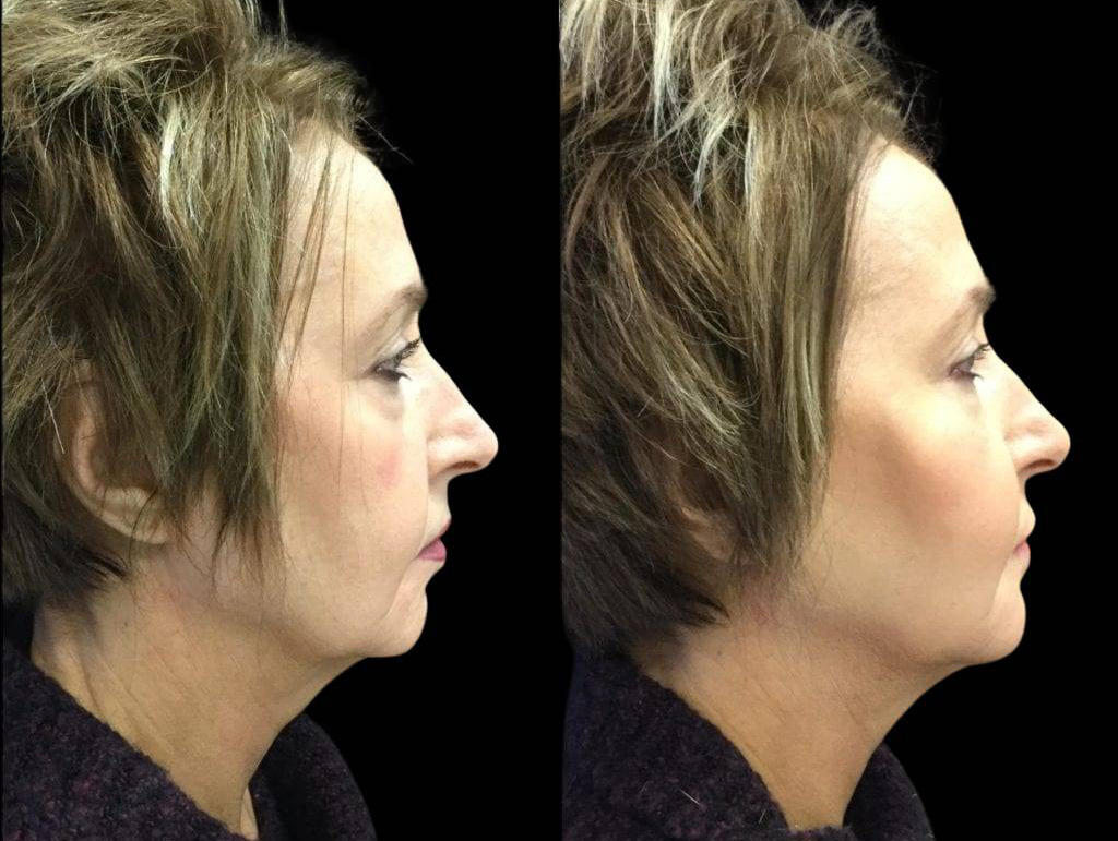 57-year-old-female-non-surgical-facelift-before-and-after-2.jpg