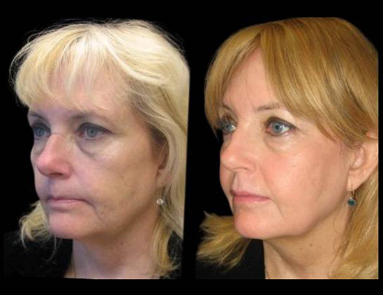 57-year-old-female-non-surgical-facelift-before-and-after.jpg