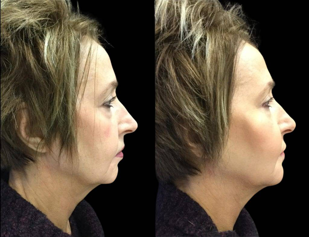 57-year-old-female-non-surgical-facelift-before-and-after-2.jpg