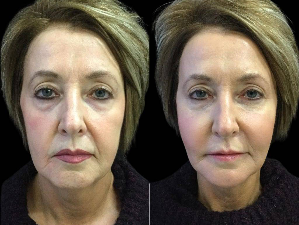 57-year-old-female-non-surgical-facelift-before-and-after-3.jpg