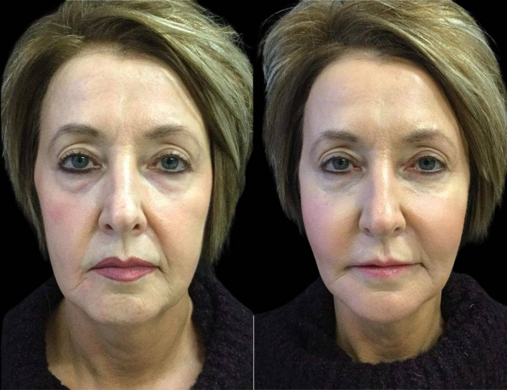 57-year-old-female-non-surgical-facelift-before-and-after-3.jpg