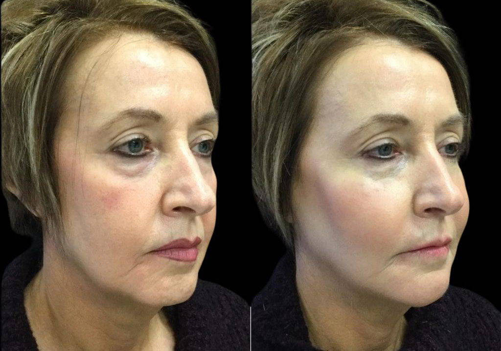 57-year-old-female-non-surgical-facelift-before-and-after-4.jpg
