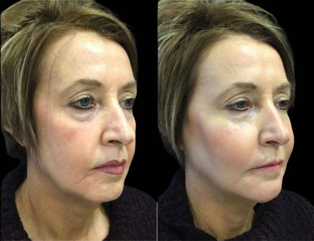 57-year-old-female-non-surgical-facelift-before-and-after-4.jpg