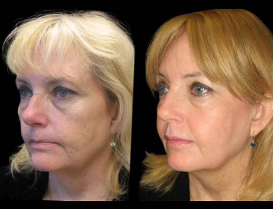 57-year-old-female-non-surgical-facelift-before-and-after.jpg