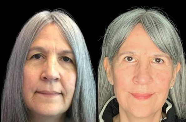57-year-old-female-upper-and-lower-eyelid-lift-before-and-after-front-view.jpg