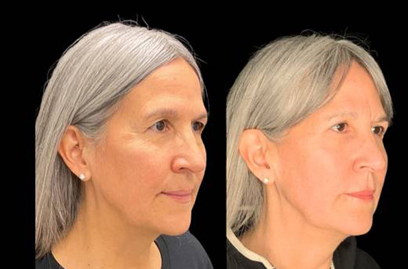 57-year-old-female-upper-and-lower-eyelid-lift-before-and-after-three-quarter-view-35037.jpg