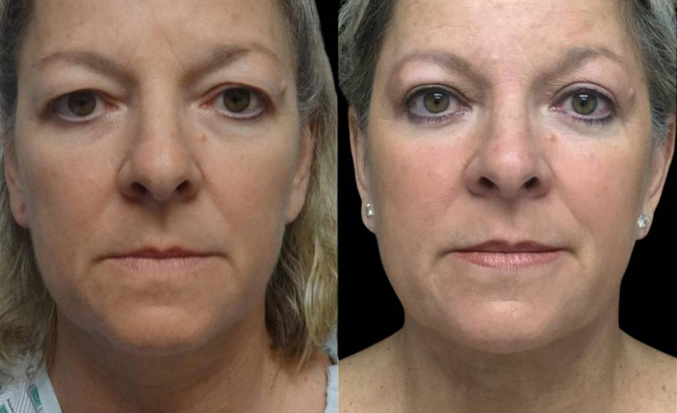 57-year-old-female-upper-eyelid-lift-before-and-after-front-view.jpg