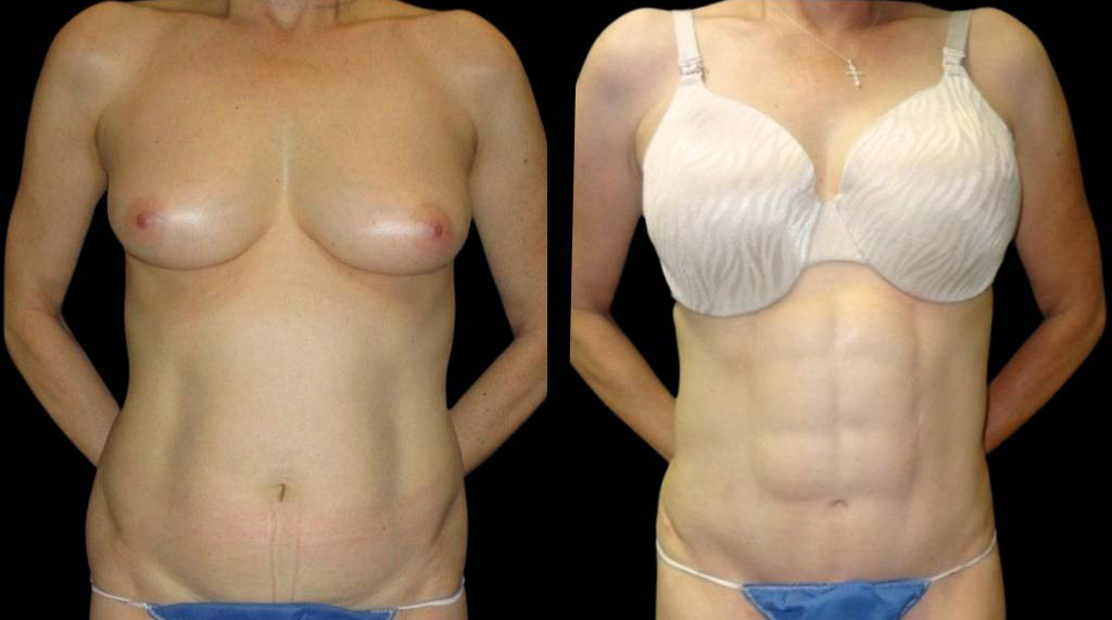 This is a 58-year-old female that has had an abdominal etching done showing the before and after's side-by-side