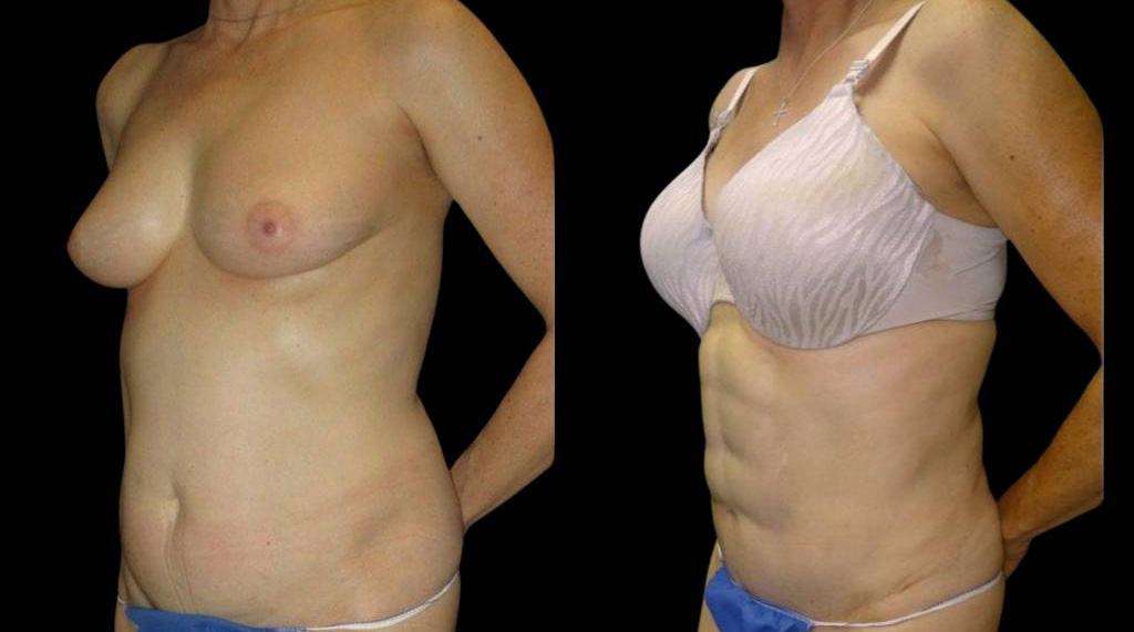 This is a 58-year-old female that has had an abdominal etching done showing the before and after's side-by-side