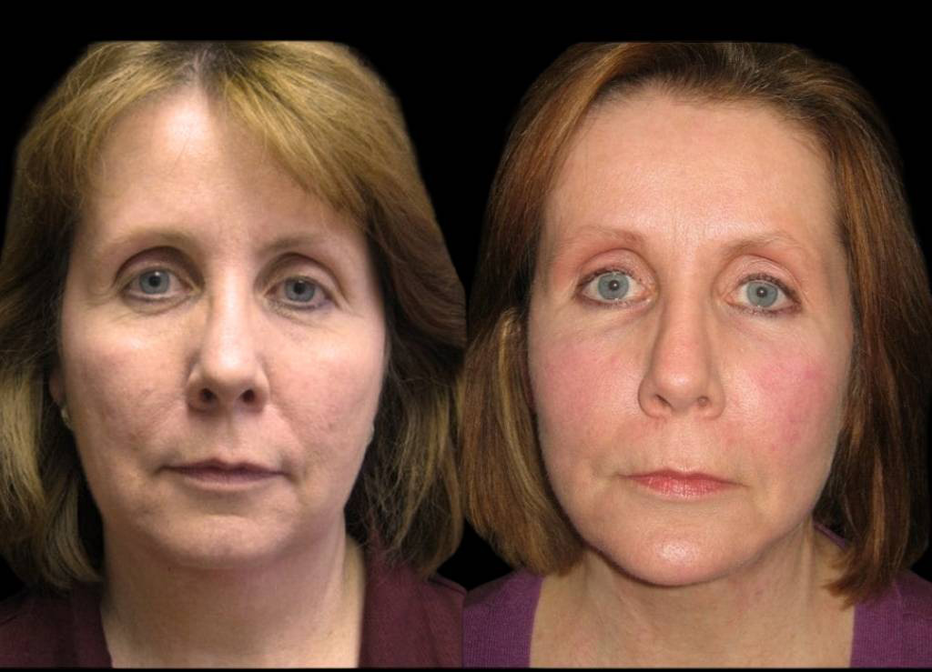 58-year-old-female-facelift-before-and-after-front-view-9958.jpg