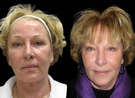 58-year-old-female-fractional-co2-laser-treatment-before-and-after-side-view