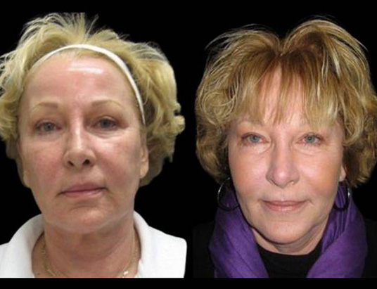 58-year-old-female-fractional-co2-laser-treatment-before-and-after-side-view.jpg