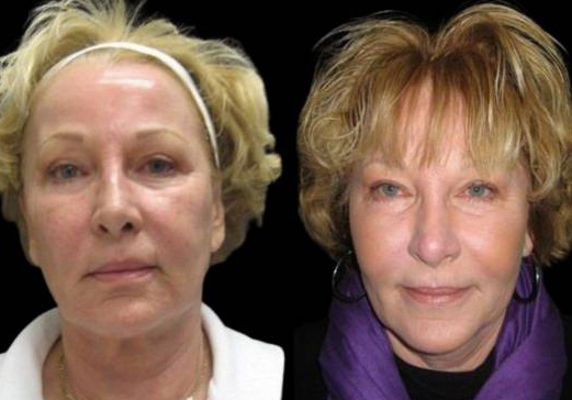 58-year-old-female-fractional-co2-laser-treatment-before-and-after-side-view.jpg