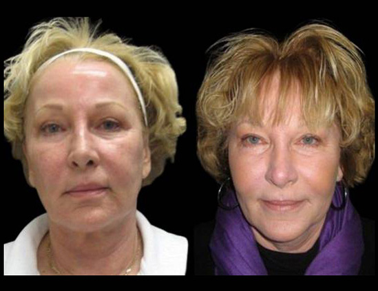 58-year-old-female-fractional-co2-laser-treatment-before-and-after-side-view.jpg