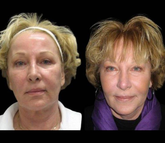58-year-old-female-fractional-co2-laser-treatment-before-and-after-side-view
