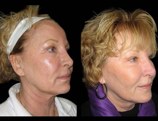 58-year-old-female-fractional-co2-laser-treatment-before-and-after-three-quarters-view.jpg