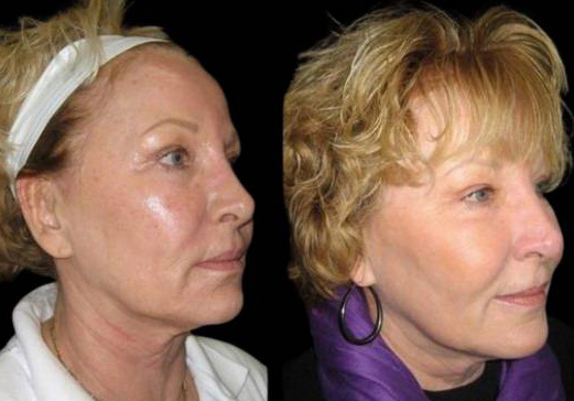58-year-old-female-fractional-co2-laser-treatment-before-and-after-three-quarters-view.jpg