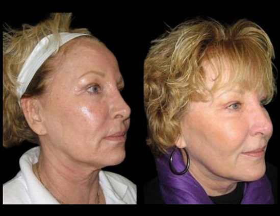 58-year-old-female-fractional-co2-laser-treatment-before-and-after-three-quarters-view.jpg