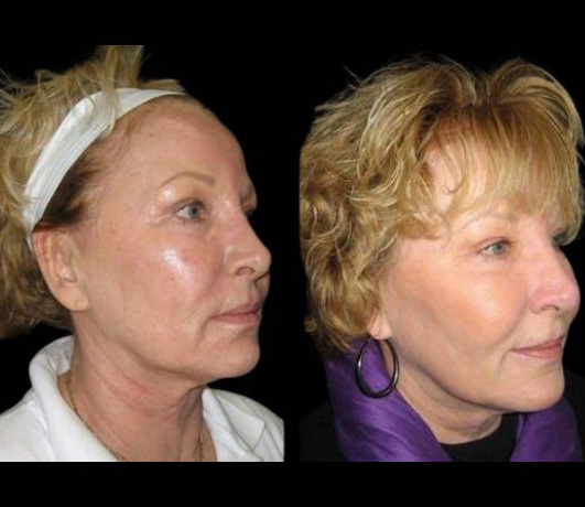 58-year-old-female-fractional-co2-laser-treatment-before-and-after-three-quarters-view