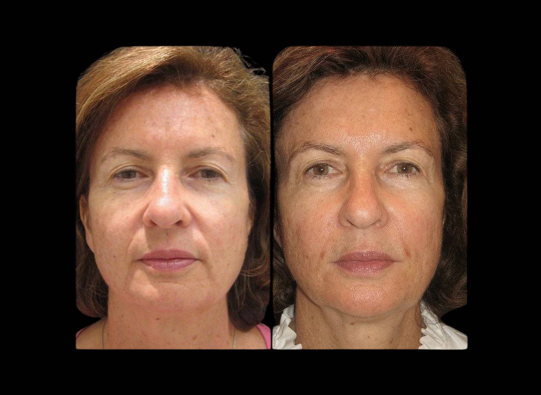 58-year-old-female-restylne-lift-before-and-after.jpg