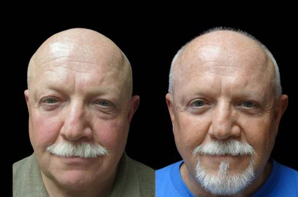 58-year-old-male-upper-and-lower-eyelid-lift-before-and-after-front-view-15413.jpg