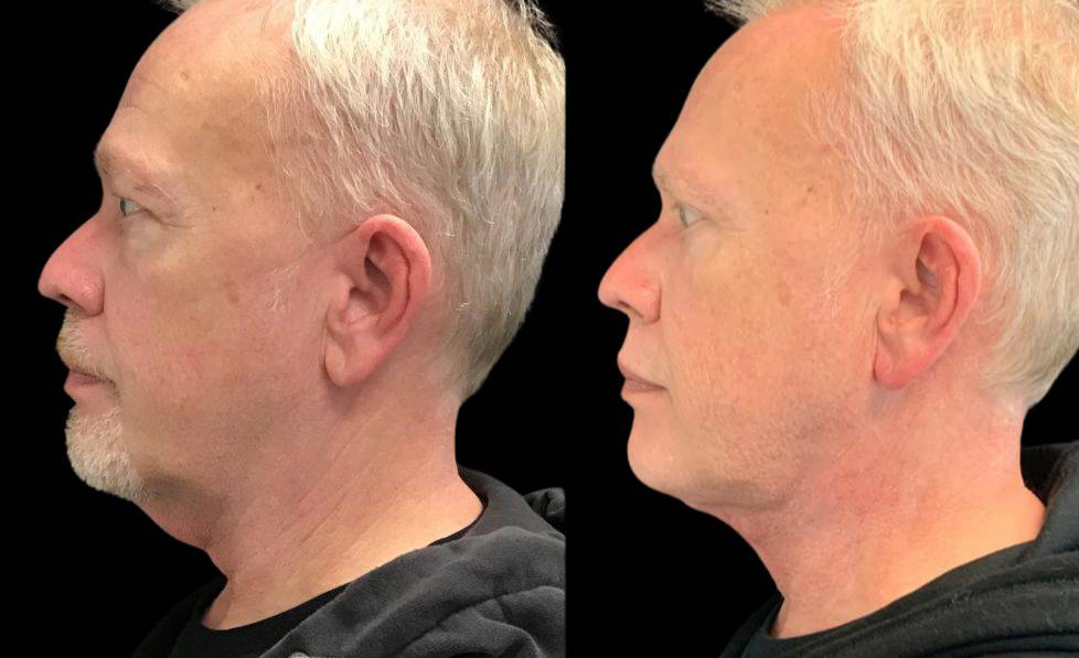 58year-old-male-necklift-before-and-after-side-view-.jpg
