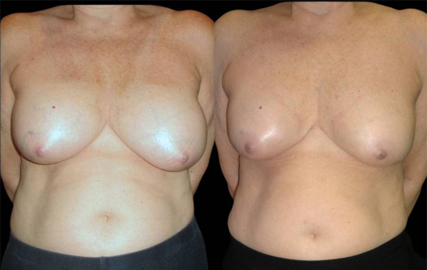 59-year-old-female-breast-reduction-by-liposuction-before-and-after-front-view.jpg