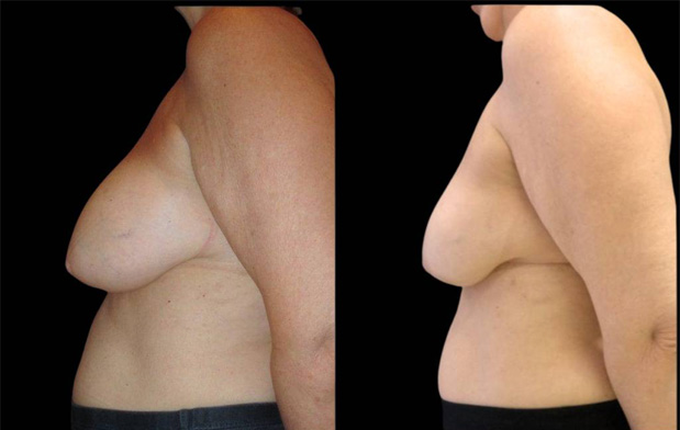 59-year-old-female-breast-reduction-by-liposuction-before-and-after-side-view.jpg