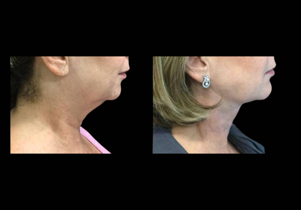 59-year-old-female-chin-implant-before-and-after-side-view-14810.jpg