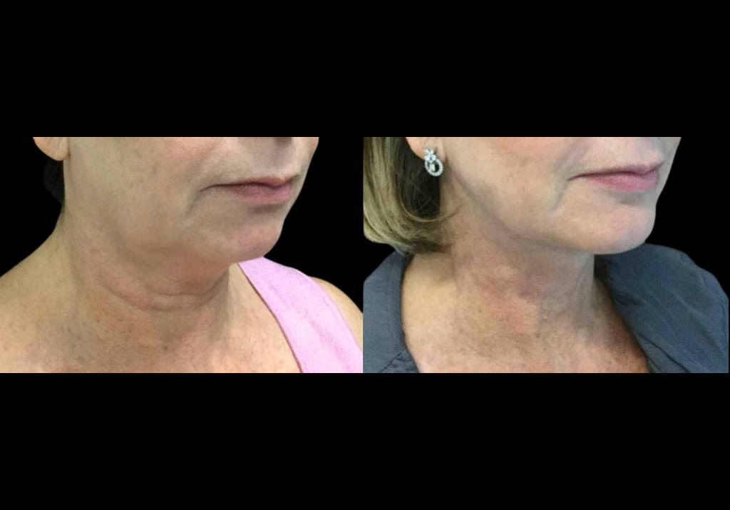 59-year-old-female-chin-implant-before-and-after-three-quarter-view.jpg