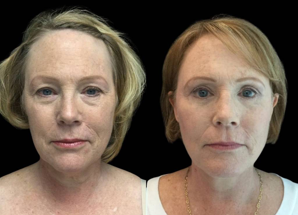 59-year-old-female-facelift-before-and-after-front-view-681.jpg
