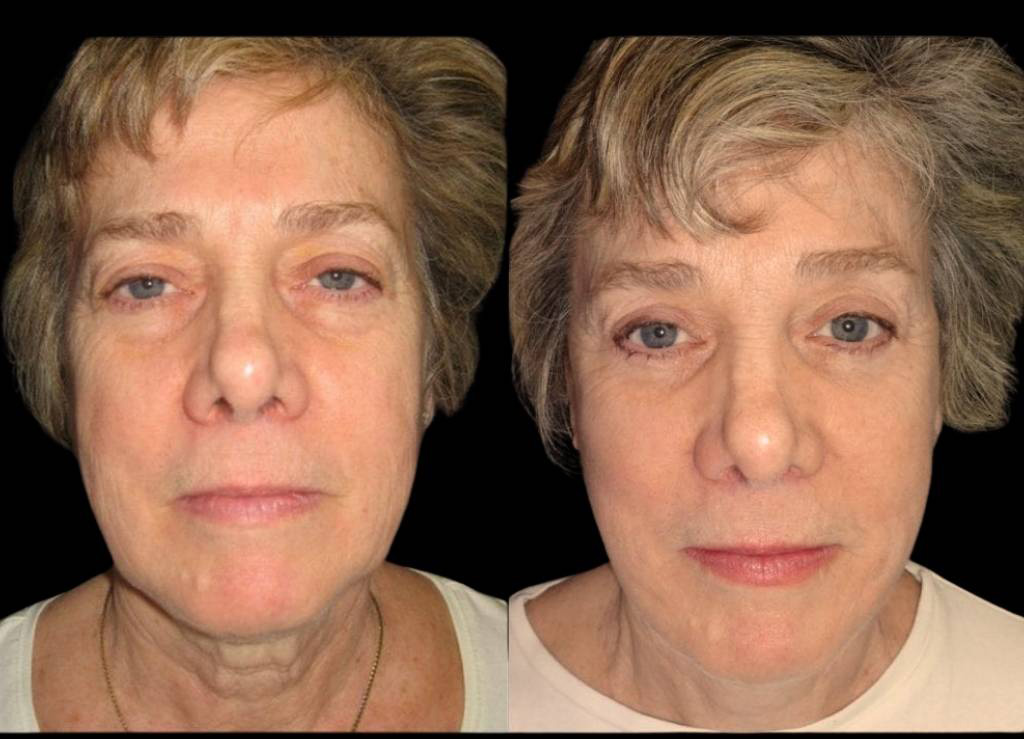 59-year-old-female-facelift-before-and-after-front-view-8281.jpg