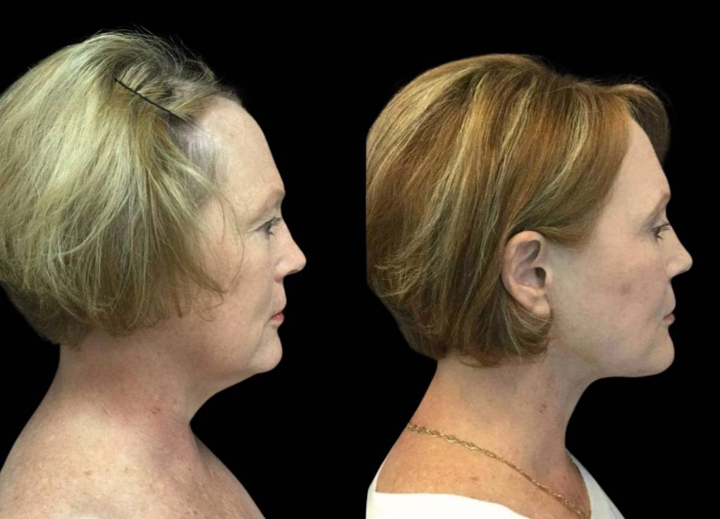 59-year-old-female-facelift-before-and-after-side-view.jpg