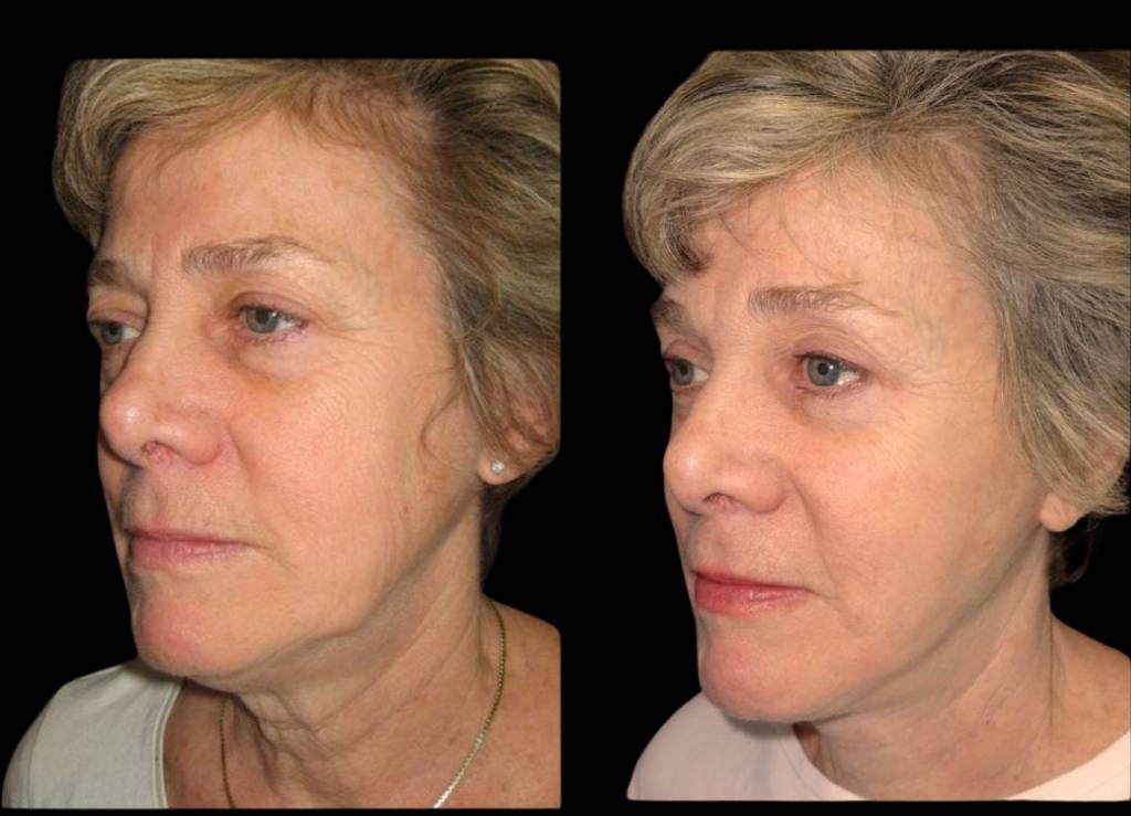 59-year-old-female-facelift-before-and-after-three-quarter-view-2.jpg