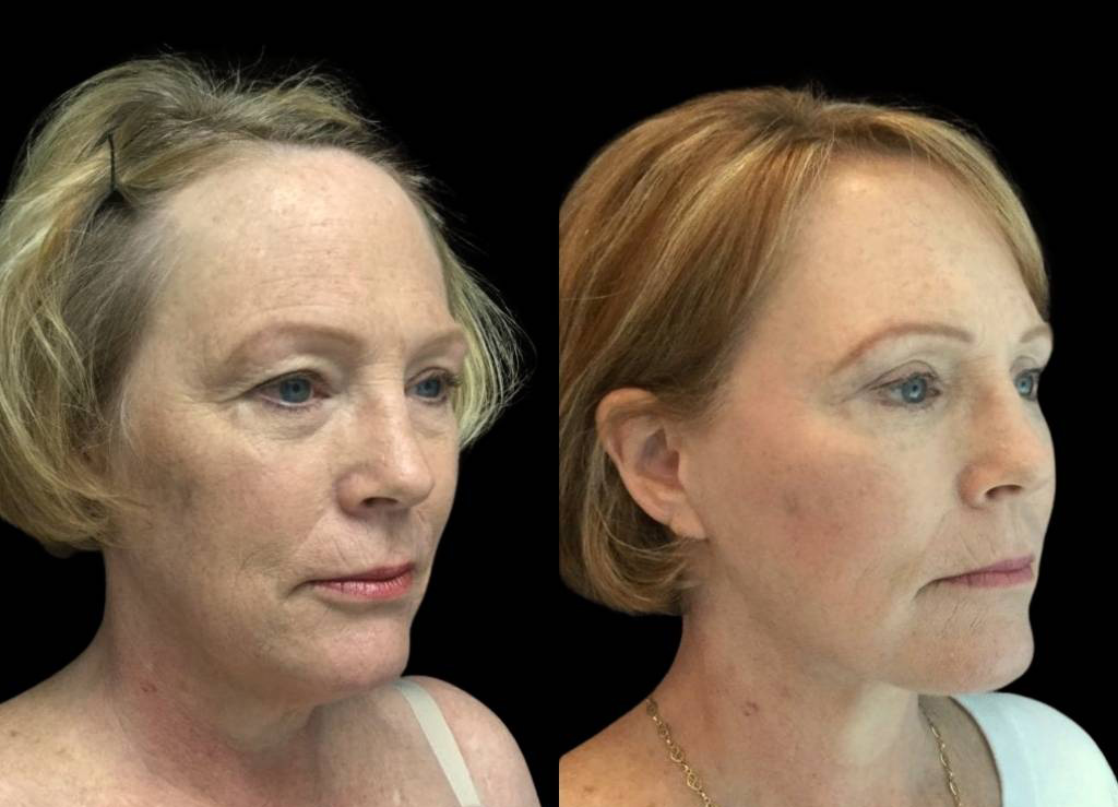 59-year-old-female-facelift-before-and-after-three-quarter-view.jpg