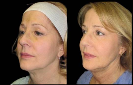 59-year-old-female-sculptra-before-and-after-1