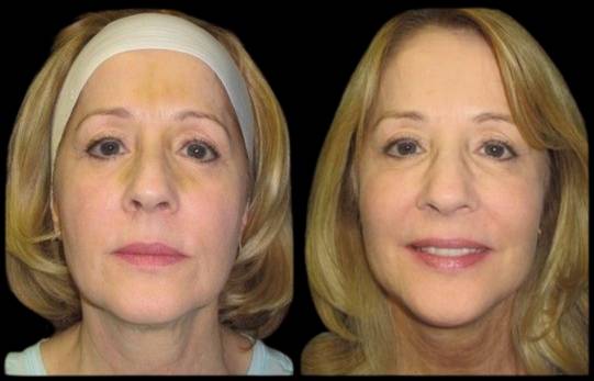 59-year-old-female-sculptra-before-and-after
