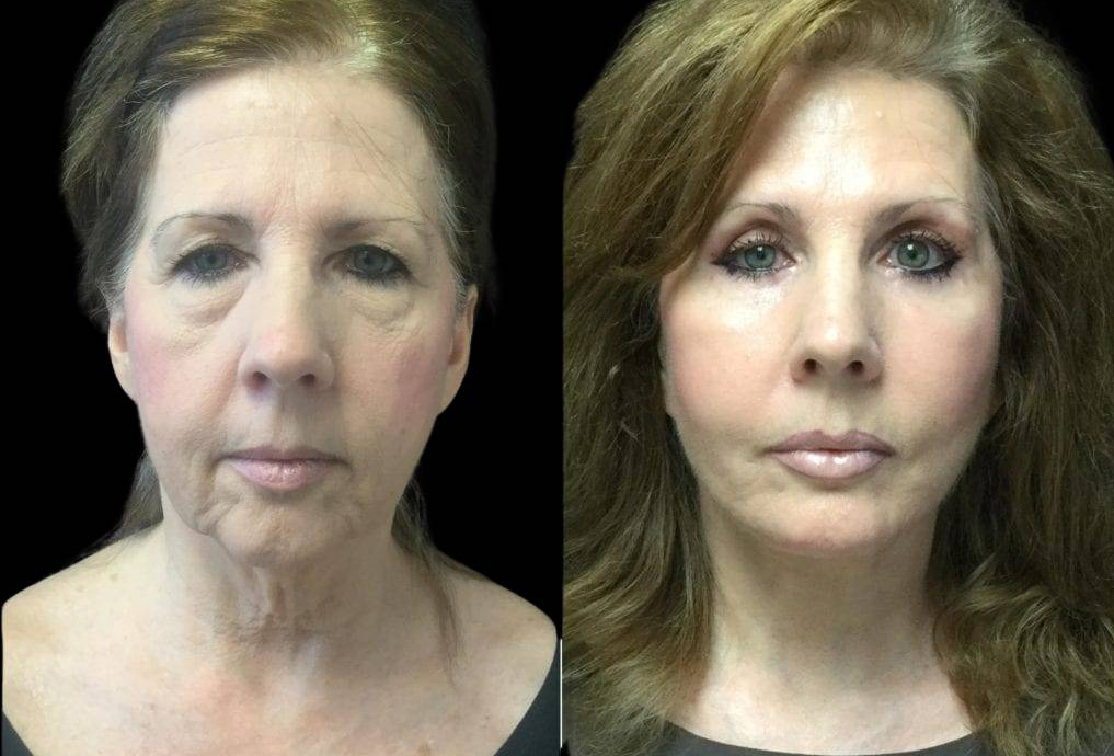 59-year-old-female-upper-and-lower-eyelid-lift-before-and-after-front-view-.jpg