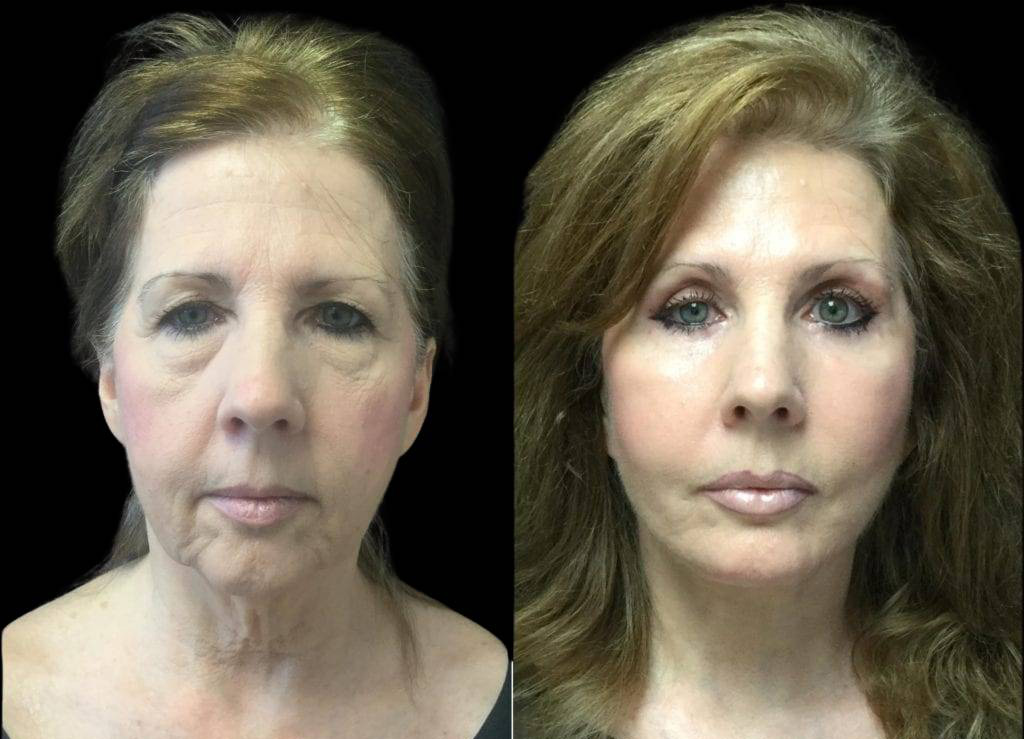 59-year-old-female-upper-and-lower-eyelid-lift-before-and-after-front-view-.jpg