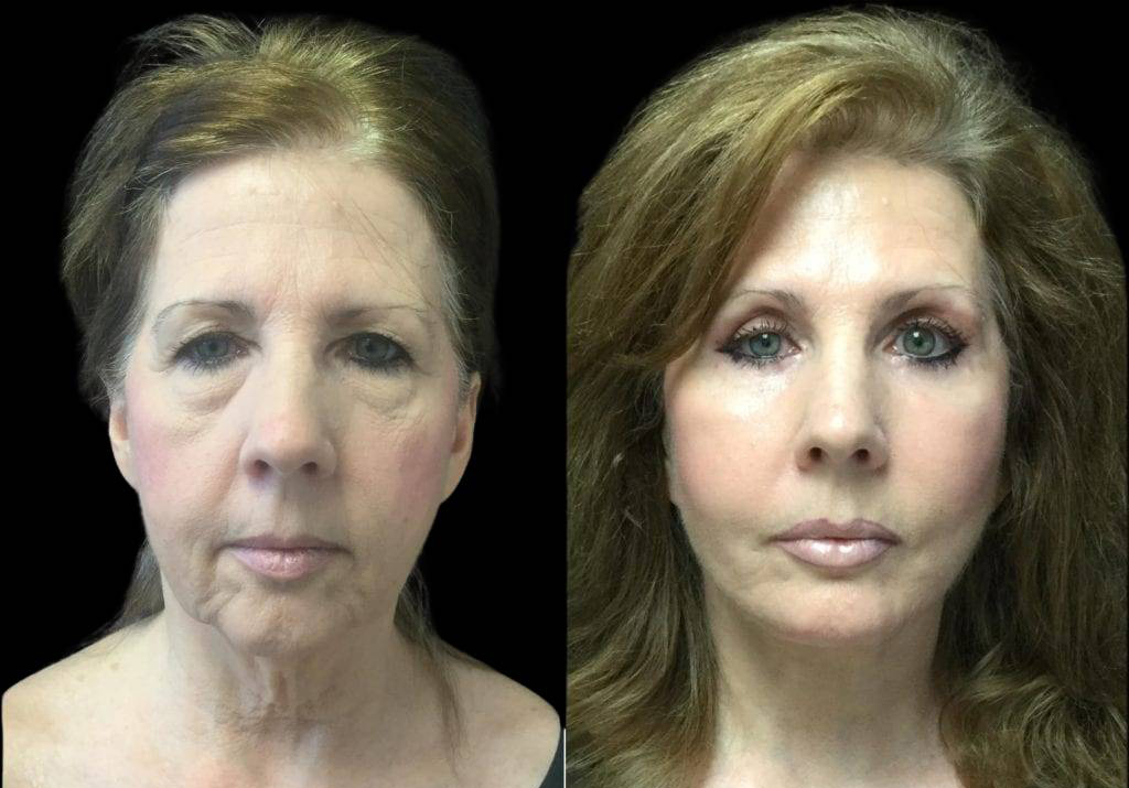 59-year-old-female-upper-and-lower-eyelid-lift-before-and-after-front-view-.jpg