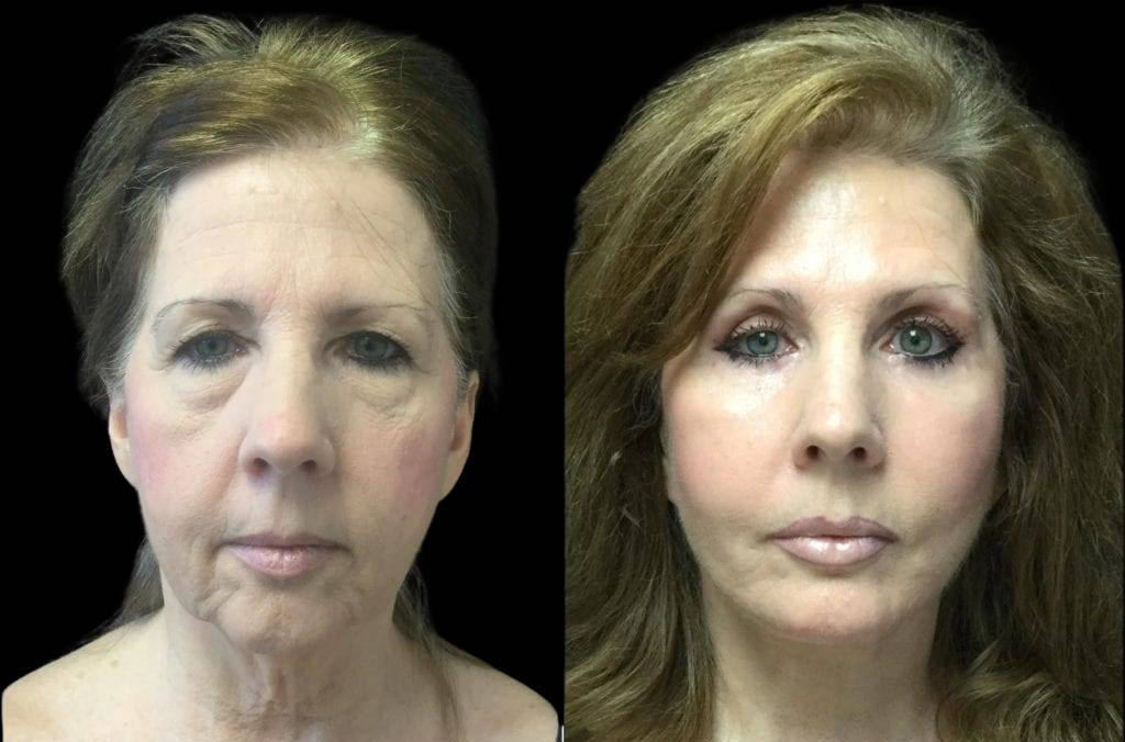 59-year-old-female-upper-and-lower-eyelid-lift-before-and-after-front-view-.jpg