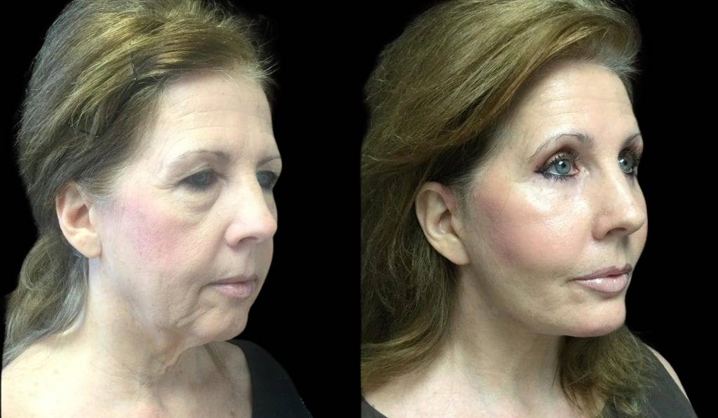 59-year-old-female-upper-and-lower-eyelid-lift-before-and-after-side-view-.jpg