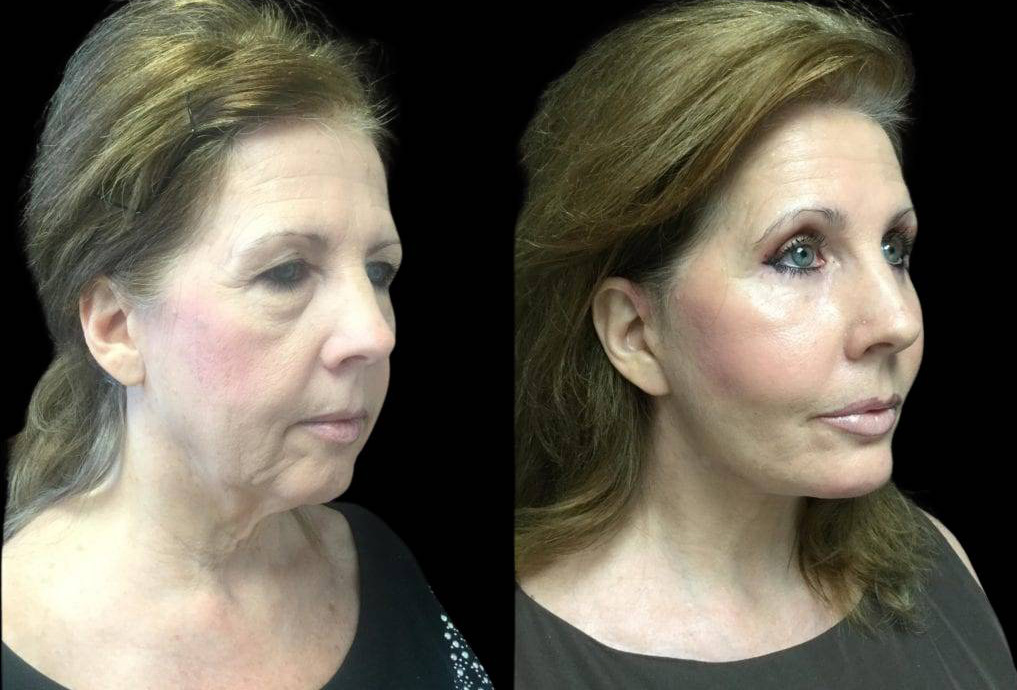 59-year-old-female-upper-and-lower-eyelid-lift-before-and-after-side-view-.jpg