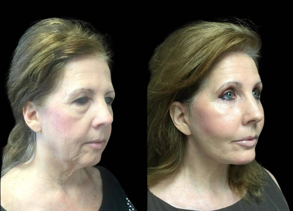 59-year-old-female-upper-and-lower-eyelid-lift-before-and-after-side-view-.jpg