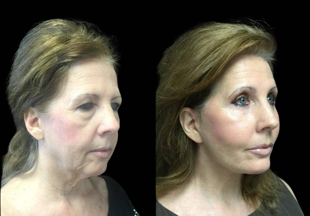 59-year-old-female-upper-and-lower-eyelid-lift-before-and-after-side-view-.jpg