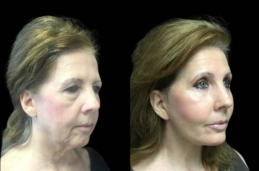 59-year-old-female-upper-and-lower-eyelid-lift-before-and-after-side-view-.jpg