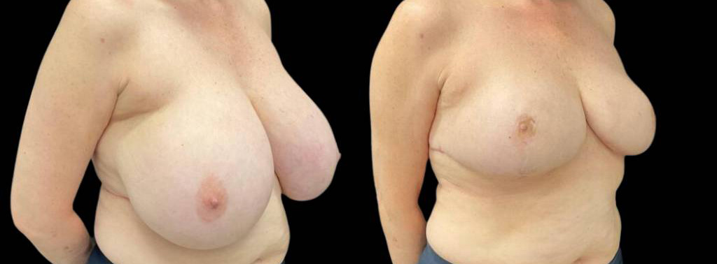 60-year-old-female-breast-lift-before-and-after-three-quarter-view-2.jpg