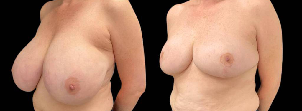 This is a 61-year-old female that has had a breast lift showing the before and after's side-by-side