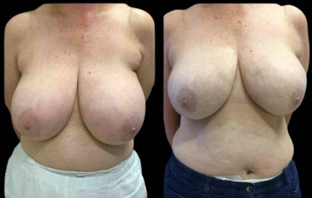 60-year-old-female-breast-reduction-by-liposuction-before-and-after-front-view.jpg